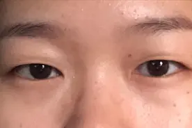 做个双眼皮要花1.5w元钱？为什么别人几百块就行？医生告诉您图片