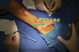 透析患者“抓握”无力 当心患上这种病图片