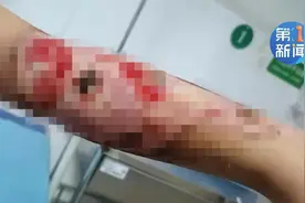 9岁女孩身体被电击！一进一出两个伤口让人心疼图片