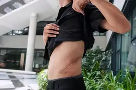 十年前卖肾买手机的小伙，如今三级伤残！人切除一个肾，危害不小图片