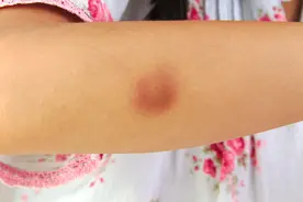 为什么会长脂肪瘤，会癌变吗？提醒：3种脂肪瘤，要及时应对图片