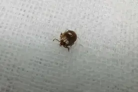 惊！8岁男孩头顶竟出现一只虫 专家提醒：蜱虫凶猛季到来，身上冒出“小黑点”别大意！图片