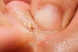 挤压抓挠后，鼻子上挤出来白色条状，是什么东西？图片