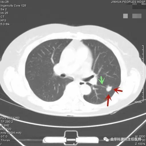 叶建明谈结节：检查发现肺实性结节怎么办？个人版实用指南