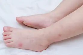 夏季蚊虫叮咬，6种止痒药膏可选择图片