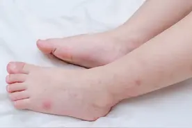 夏季蚊虫叮咬，6种止痒药膏可选择图片