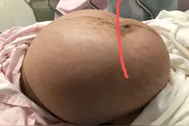 怀孕8月从未产检，19岁女生体内长30多斤肿瘤……医生都吓一跳图片