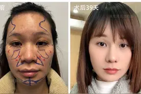 35岁深圳女子，1次整容就做了10个部位，衰老真那么可怕吗？图片