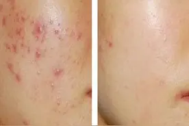脸上长痘反复痛痒，别糊乱涂祛痘膏，老中医说：看好部位针对祛痘图片