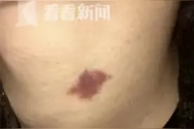 脖子上出现“草莓印”？女友认定是吻痕要分手 男子：冤枉啊图片