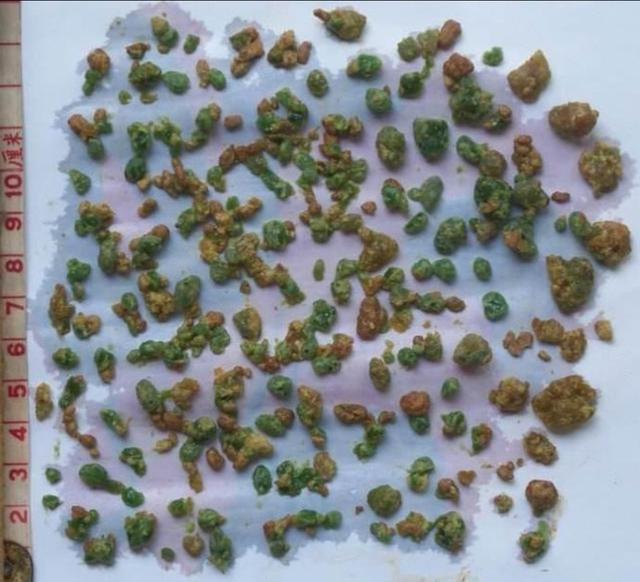 静脉输氨基酸需警惕啦！报告称有草酸钙沉淀，易患肾结石！