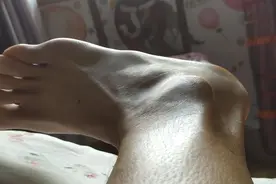 脚踝撕脱性骨折第64天图片