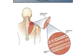 一图读懂自我筋膜放松图片