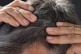 米诺地尔的这些副作用，你一定要知道图片