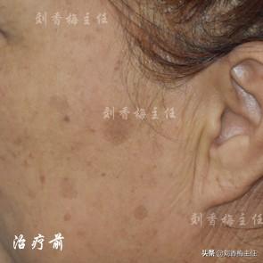 小腿脂溢性角化病