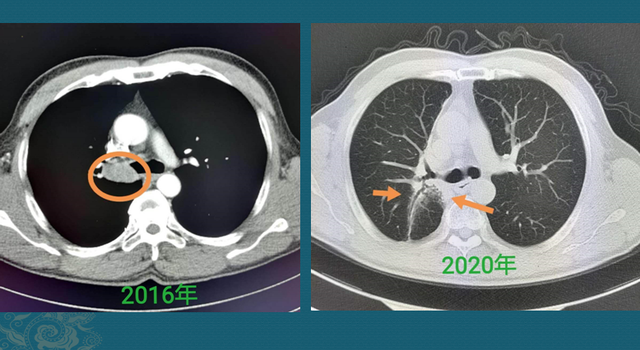 非角化型鳞癌胸腺
