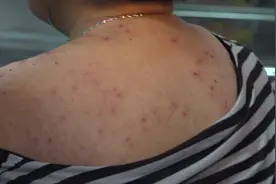 密密麻麻！浙江女子遭到蜂群“猛攻”，全身被拔出400多根刺图片