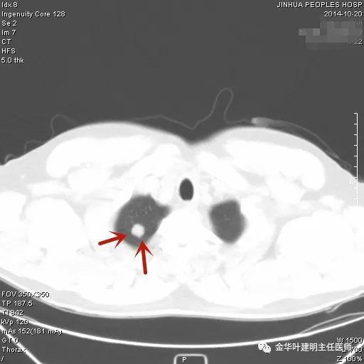 叶建明谈结节：检查发现肺实性结节怎么办？个人版实用指南
