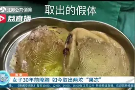 30年前爱美隆了胸，女子如今手术取出两“果冻”：身体多处组织坏死图片