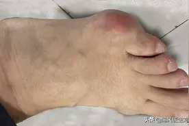痛风发作时能忍则忍，实在痛到不能忍再吃止痛药？医生辟谣图片