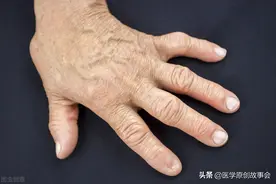 别把肺癌当成骨质增生，手指若有一个表现，可能是肺部在“求救”图片