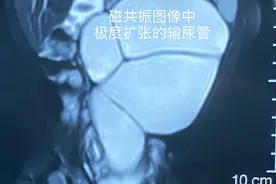 女婴长了“三个肾”输尿管扩张“粗如肠”泰安市妇幼保健院外三科医生微创技术来帮忙图片