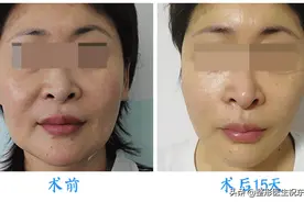 做了4次线雕，改做拉皮手术后，我才明白的4件事图片