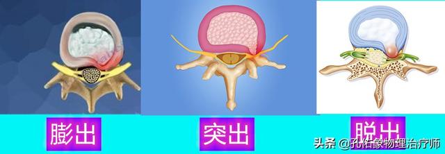 若您患有腰椎间盘膨出，不知怎么办？孔医生教您3种最核心的方法