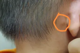 孩子淋巴结肿大是怎么回事？图片