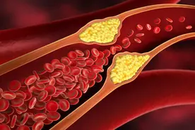 他汀药物的4个常见副作用，医师提醒：这6种方法可降低风险图片