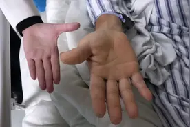 二次发育？56岁男子身体突然出现奇怪变化：个头儿“猛窜”，四肢变肥大图片