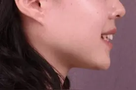 成都牙齿矫正｜五官立体，正畸拔牙要慎重图片