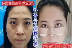 51岁大姐外切眼袋术后10天，女儿说妈妈年轻了十岁图片