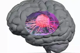 怎样的头痛是脑瘤的症状？脑压上升并出现这些征兆有危险图片