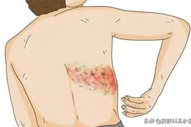 疼起来要命的“缠腰龙”，医生：其实并不难应付，得积极就医图片