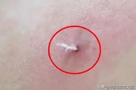 民间很有效的治病方法——挑羊毛疔图片