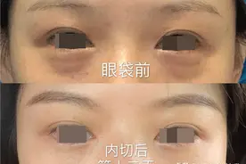 说一说我在北京做“内切祛眼袋手术”的一点感受图片
