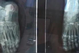跖骨基底骨折两个月的切身体会图片