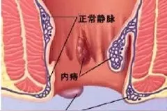 结缔组织性外痔是什么原因？该如何预防？图片