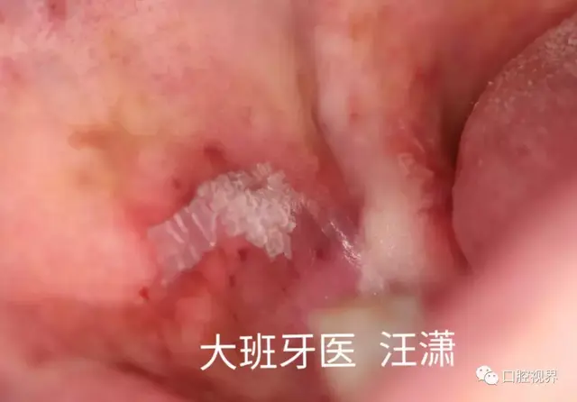 舌头有三块白色角化