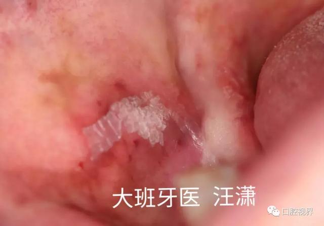 口腔白色角化性