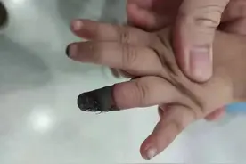 警惕！家人错误包扎致3岁女童手指坏死，创可贴要这么用图片