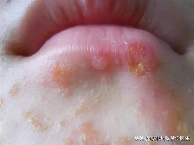 毛周角化症用酮康唑可以吗