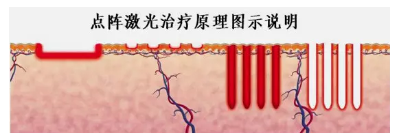 点阵激光祛毛囊角化