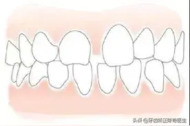 牙列间隙是什么？应该怎么办？图片