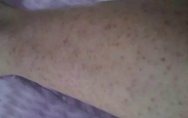 鸡皮肤的专业名字叫什么