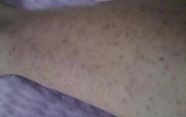 人的皮肤像鸡皮一样的 人的皮肤像鸡皮一样的