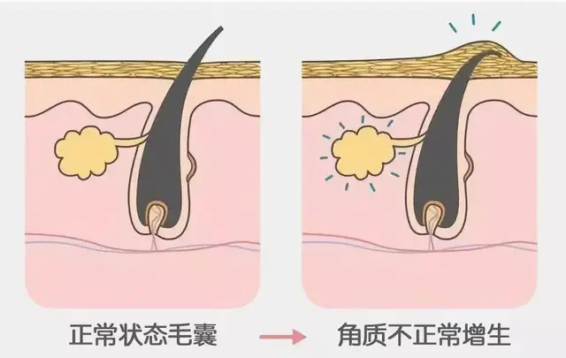 毛囊炎和毛周角化症图片