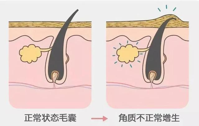 全身像鸡皮疙瘩图片