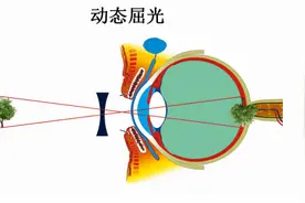 眼科医生给近视矫正者的几个“忠告”图片